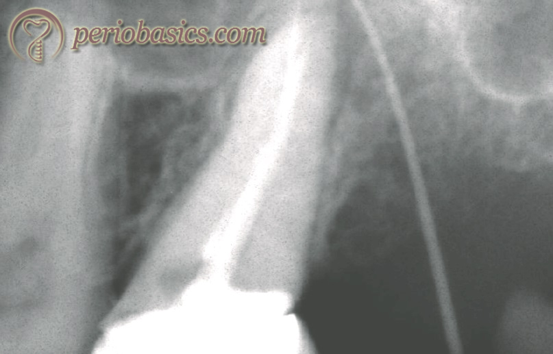 Gutta purcha cone inserted from the draining sinus indicating the involved tooth