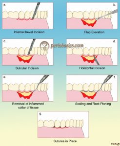 History of surgical periodontal pocket therapy and osseous resective ...