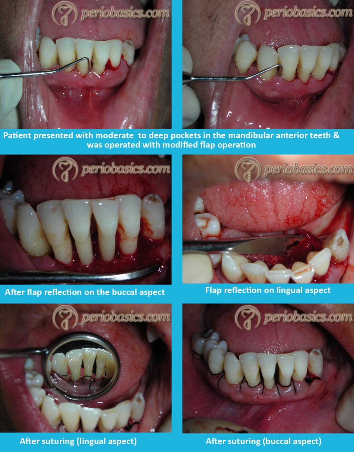 periodontal-flap-surgeries-current-concepts-periobasics