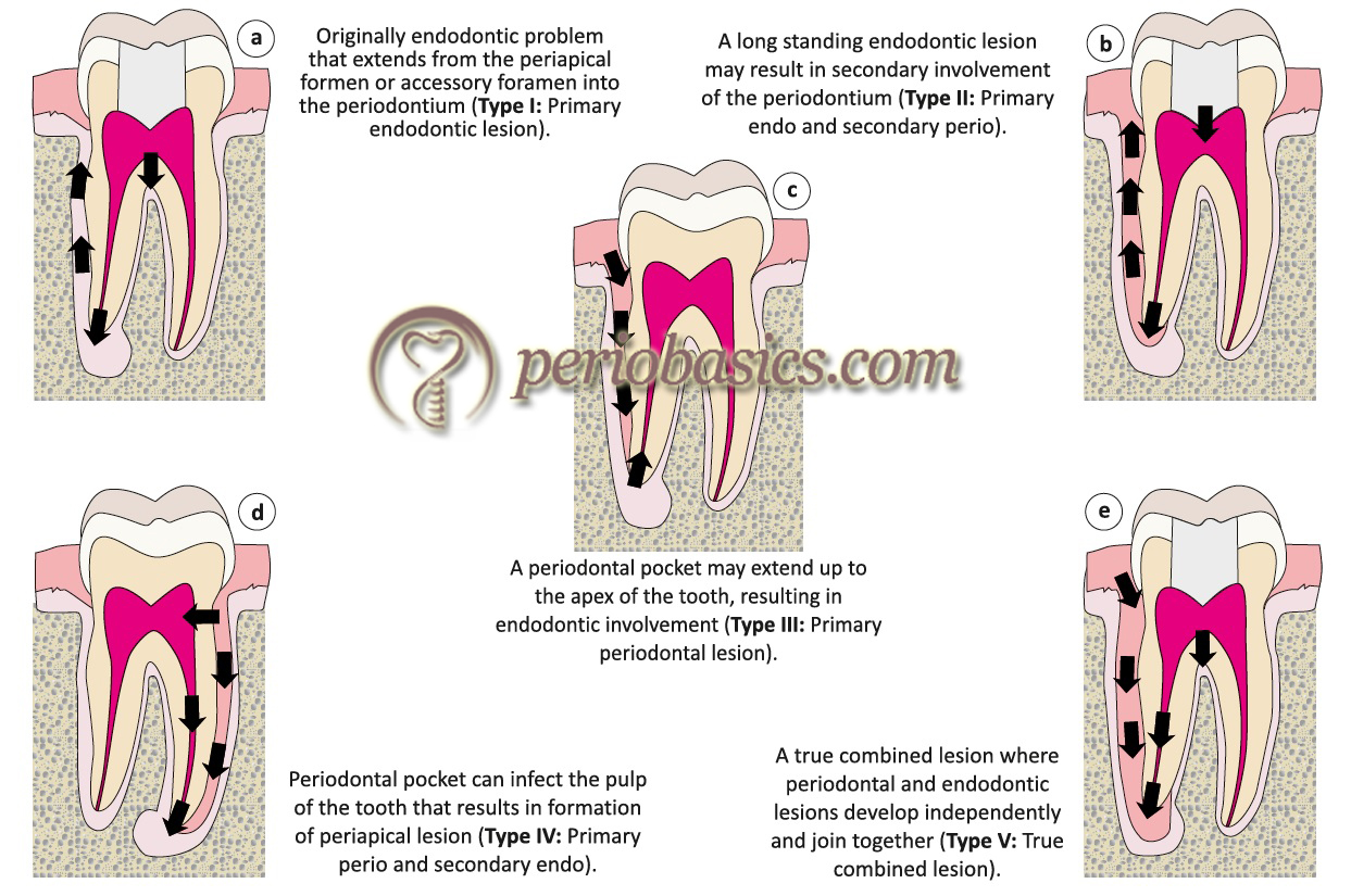 Endo Perio Lesion Classification