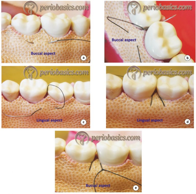 Sutures And Suturing Techniques 4292