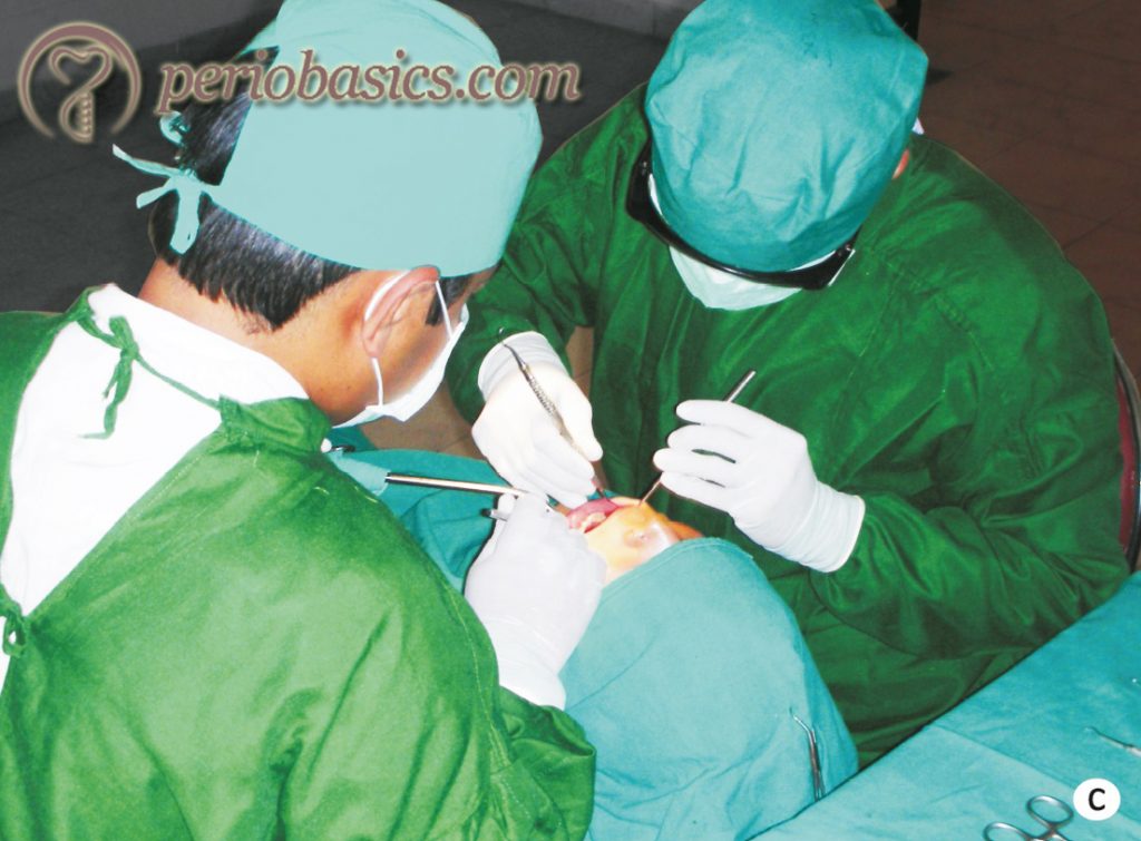 The protocol followed during periodontal surgeries. 