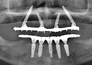 Angulated implants