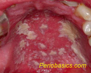 Clinical photograph of pseudomembranous candidiasis