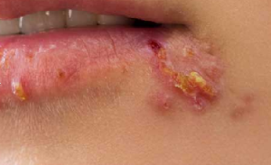 Herpes simplex virus lip infection