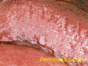 Hyperplastic candidiasis on the lateral border of tongue