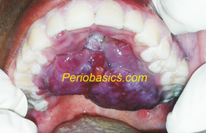 Kaposi's Sarcoma