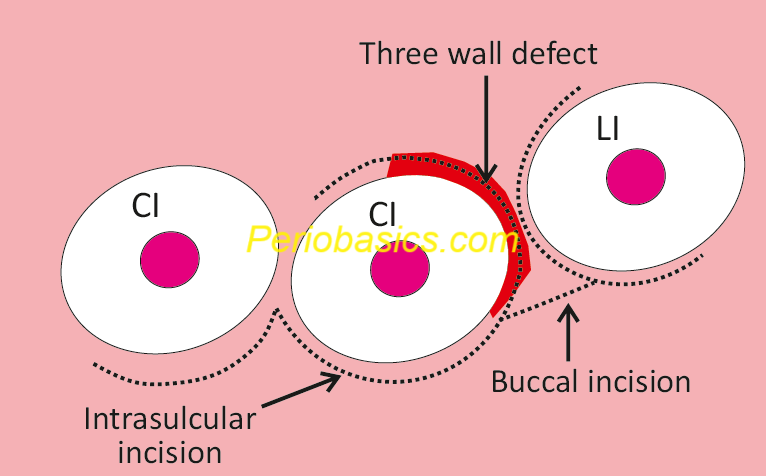 Minimally invasive surgical technique incisions in wide interproximal defects