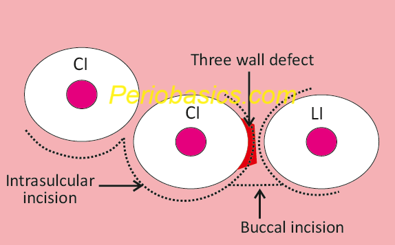 Minimally invasive surgical technique incisions