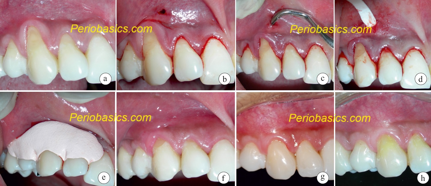 Pinhole surgical technique