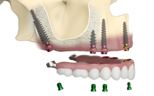 Pterygoid implants