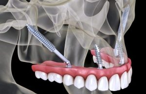 zygomatic implants